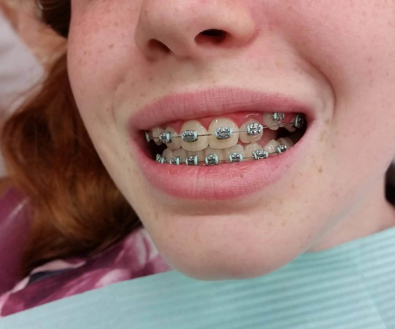 "Mi mamá me obligó a ponerme brackets" "Mi mamá me obligó a ponerme brackets"