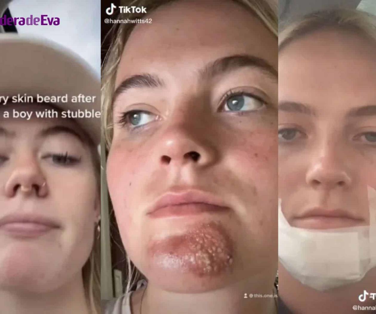 ¿Qué hacer si la barba de tu pareja te irrita la cara?