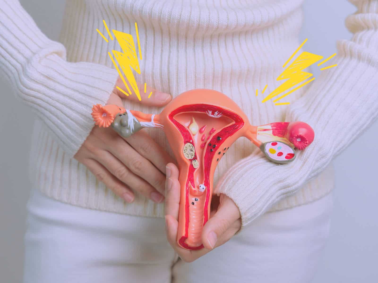 Endometriosis: Estas son las voces del dolor